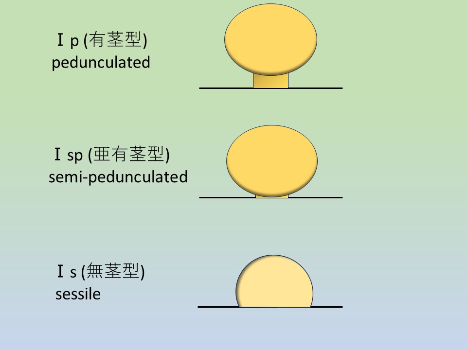 大腸ポリープの形態学的分類　Ip　Isp　Ip